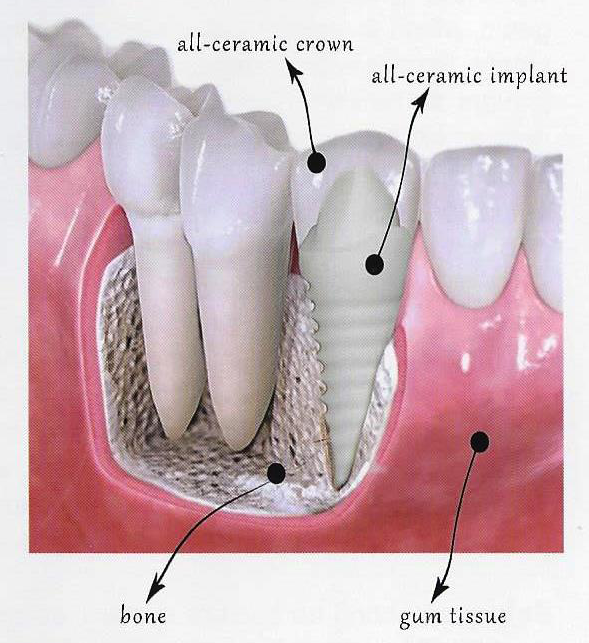 CeraRoot dental implants in Fresno and Clovis