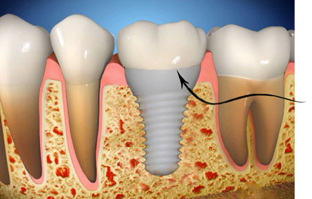 Ceramic tooth implants in Clovis and Fresno drawing