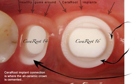 Ceramic dental implants in Fresno description