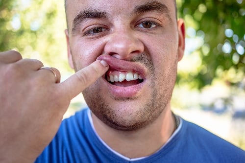 man in a blue shirt exposing his chipped tooth