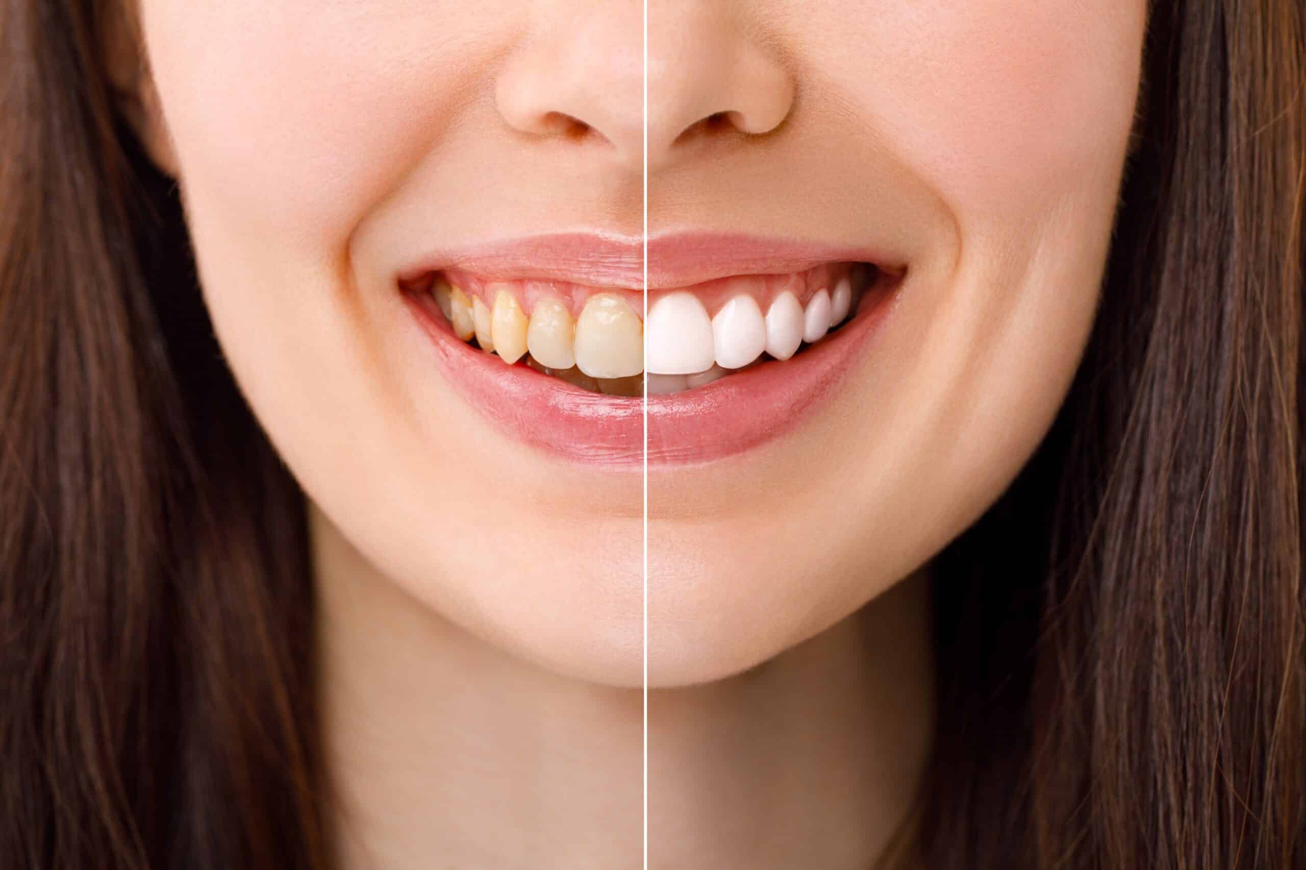 before and after of a professional teeth whitening treatment